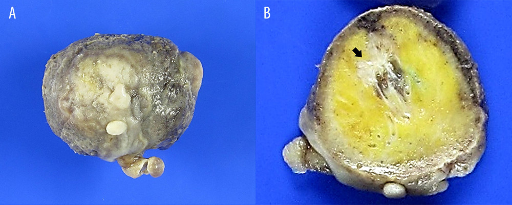 Macroscopic findings for the specimen. (A) A large part of the surface is ulcerated and the remaining surface (center) is covered with white-to-gray, wrinkled mucosa. No hair is noted. (B) The cut surface of the mass reveals yellow adipose and hard bony tissue (arrow).