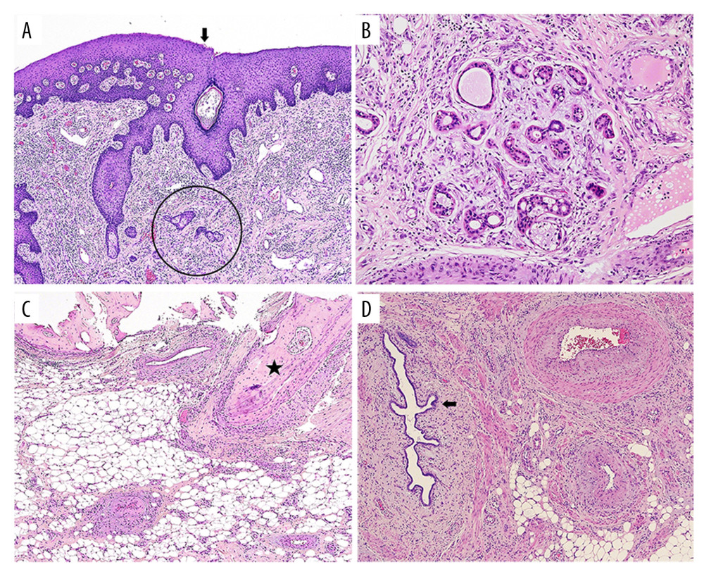 Microscopic findings for the mature teratoma. (A) Squamous epithelium (arrow) with hair follicles (circle) (hematoxylin & eosin [H&E], original magnification ×40). (B) Sweat glands (H&E, 100). (C) Adipose tissue and bone (asterisk) (H&E, original magnification ×40). (D) Glandular epithelium (arrow) and blood vessels (right side) (H&E, original magnification ×40).