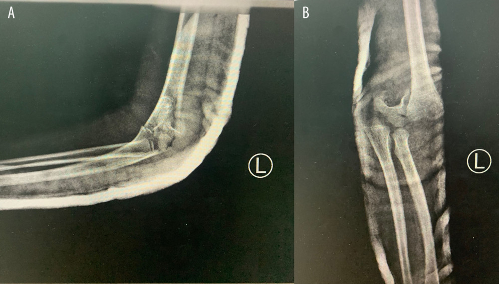 Left elbow X-ray. Lateral (A) and AP (B) views, with both figures showing posteromedially displaced supracondylar fracture extension type.