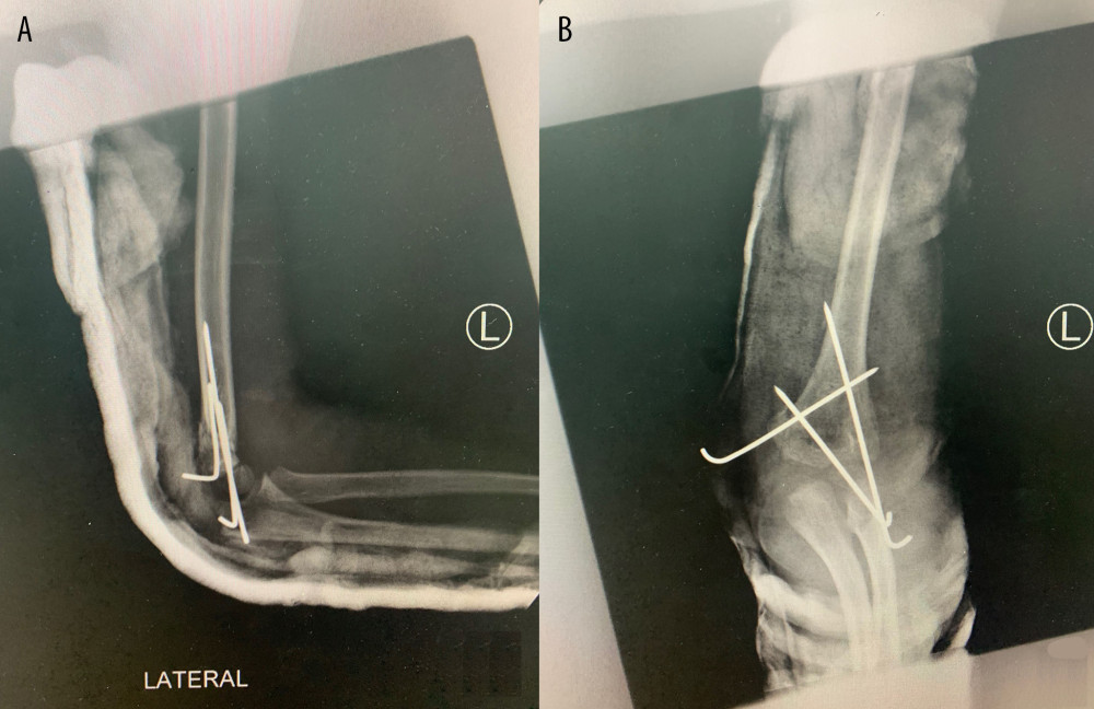 X-ray after CRPP left elbow. Lateral (A) and AP (B) views. Both figures show proper placement of the pins inserted during the procedure (2 lateral diverging pins and 1 medial crossing pin).