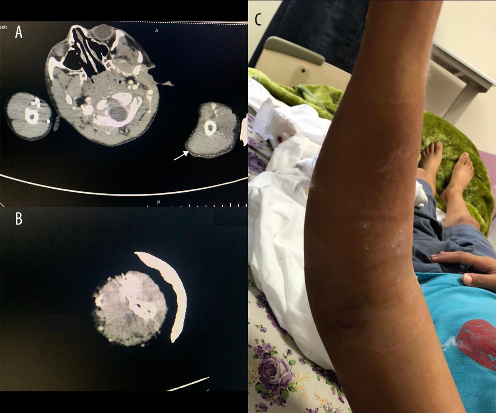 (A) Cross-sectional CT scan of both upper limbs. This image reveals a large hematoma in the posterior compartment of the arm. Arrow and dashed circle indicate the hematoma. (B) Cross-sectional contrast CT study of left arm reveals a large hematoma in the posterior compartment of the arm and subcutaneous edema. (C) Left elbow gross image; the figure shows significant tense swelling over the posterior aspect of the arm, elbow, and forearm.