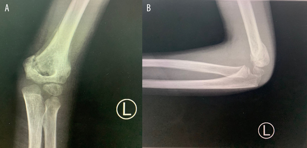 Left elbow x-ray after k wires removal 4 weeks after the surgery. AP (A) and lateral (B) views, showing proper healing of the fracture.