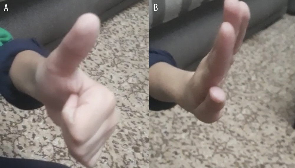 (A, B) Gross image of the left hand 2 months after surgery, demonstrating full recovery of wrist extension, thumb abduction and extension, and index finger extension.