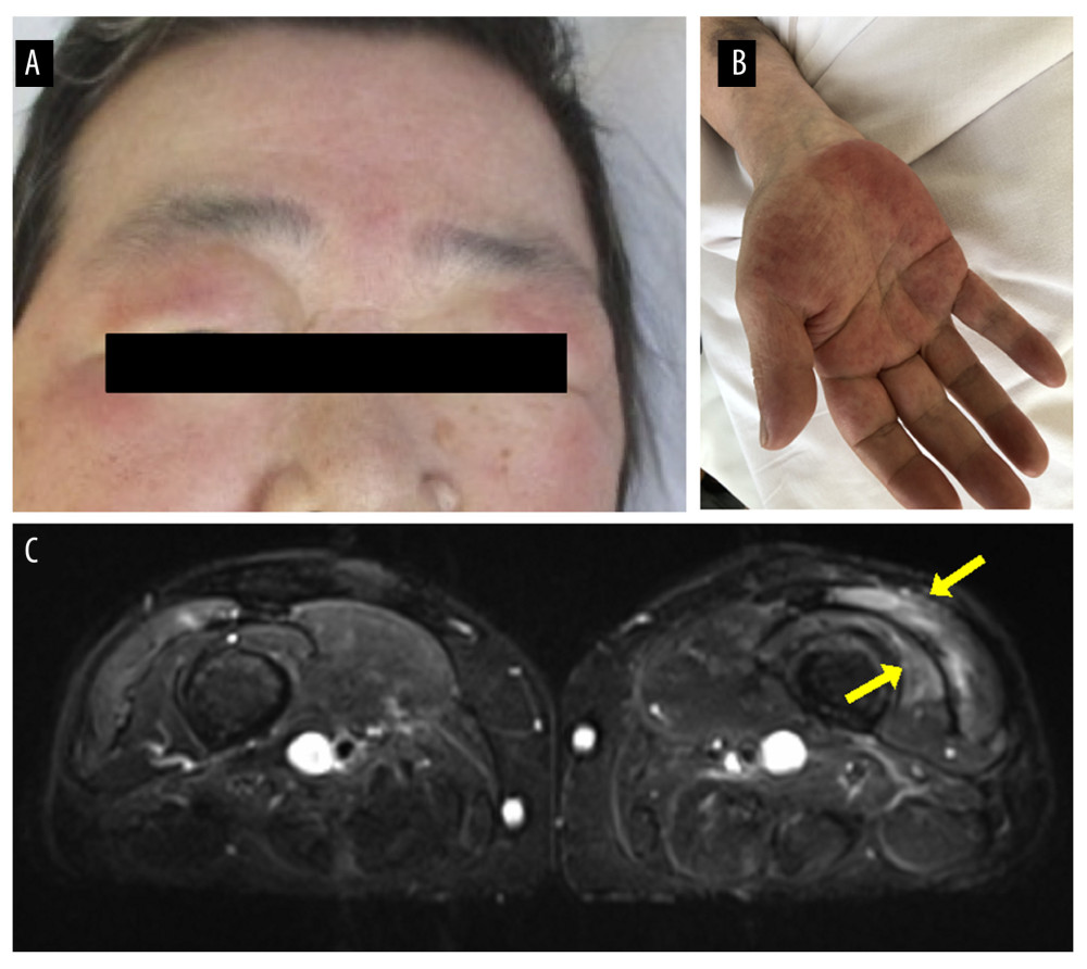 Clinical features of the patient. (A) Edema with erythema of the eyelids indicating heliotrope rash and (B) edema of the right palm. (C) A magnetic resonance imaging scan of both thighs showed signal abnormalities in the left lateral and distal vastus medialis muscles.
