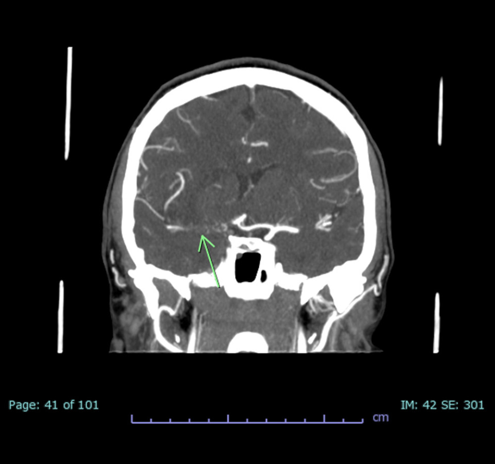 CT angiography demonstrating occlusion of the supraclinoid portion of the right internal carotid artery and M1 segment of the right middle cerebral artery (arrow).