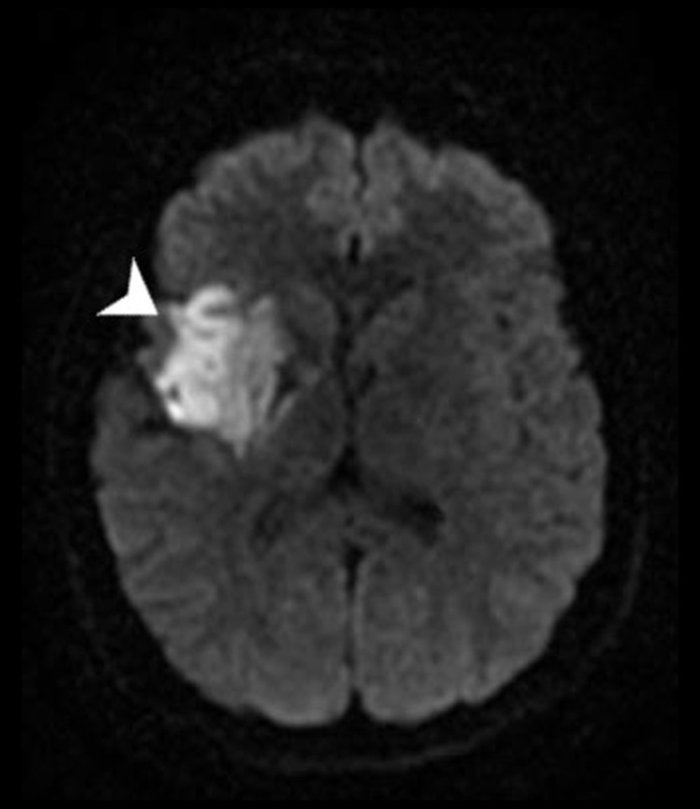 Magnetic resonance imaging (MRI) showing a small area of acute infarct in the right basal ganglia and right insular cortex (arrowhead).