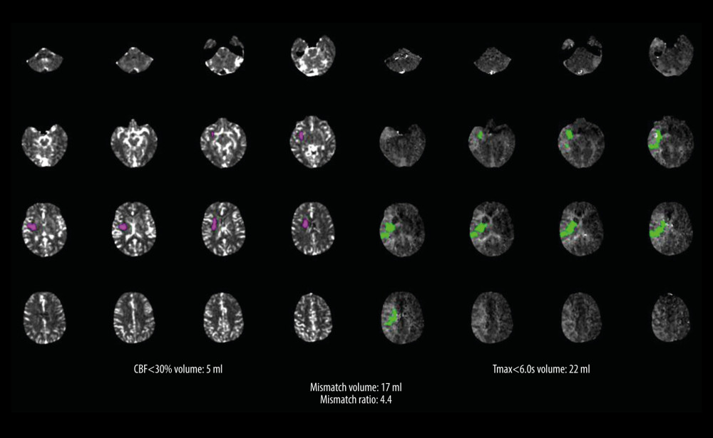 CT cerebral perfusion analysis showing a small region of complete infarct with a comparatively large ischemic penumbra (5 and 17 mL, respectively).