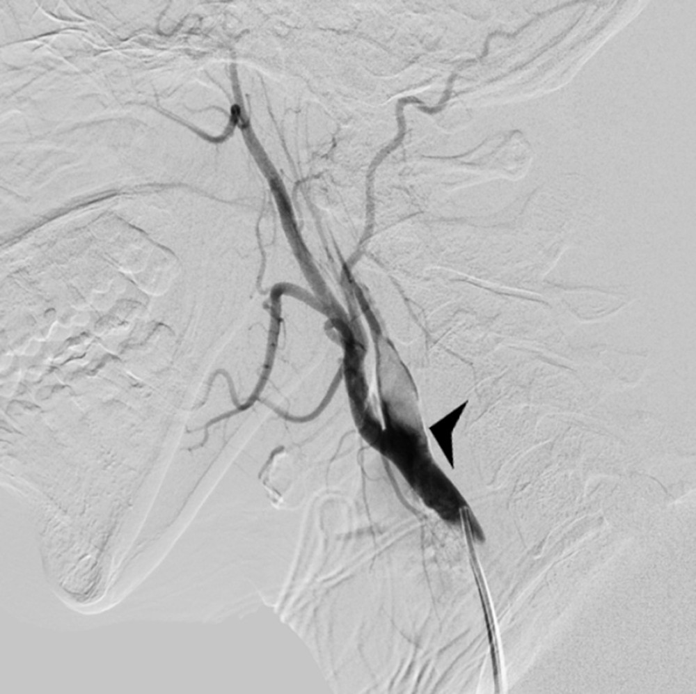 Right cervical carotid angiogram demonstrating dissection of the right internal carotid origin with intramural hematoma (arrowhead).