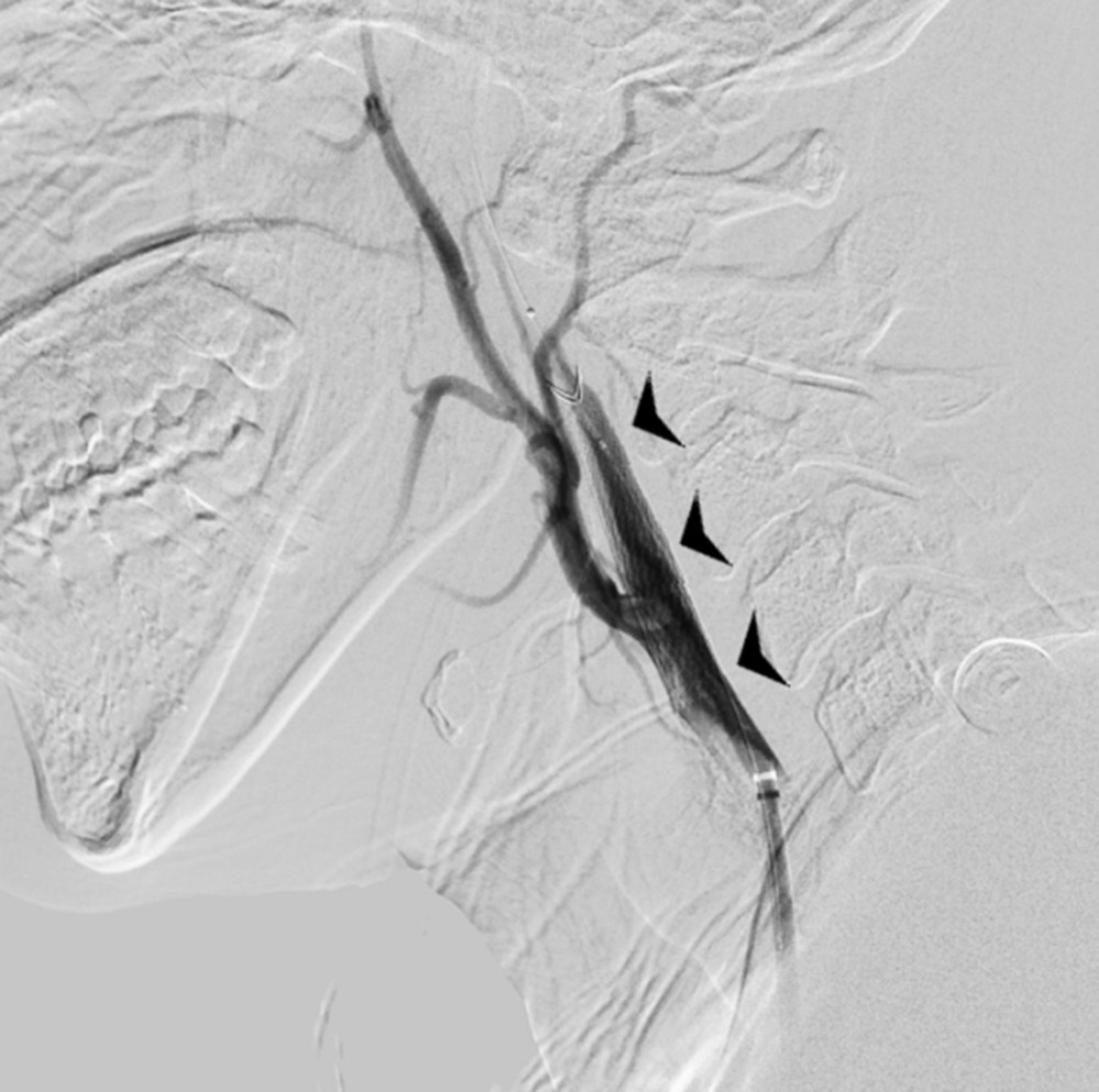 Digital subtraction angiography (DSA) demonstrating the internal carotid artery stent with embolic protection device (arrowheads).