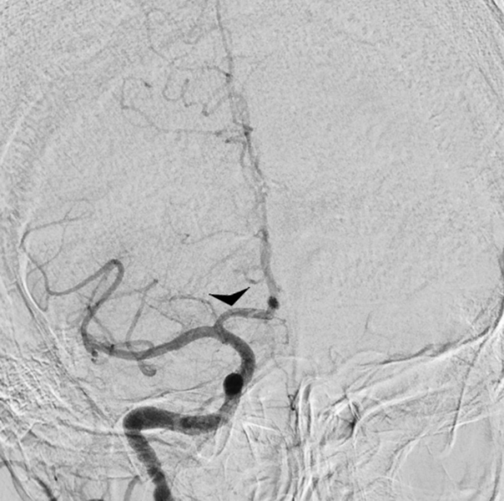 Post-thrombectomy angiography showing a patent right internal carotid artery and M1 segment of the middle cerebral artery (arrowhead).