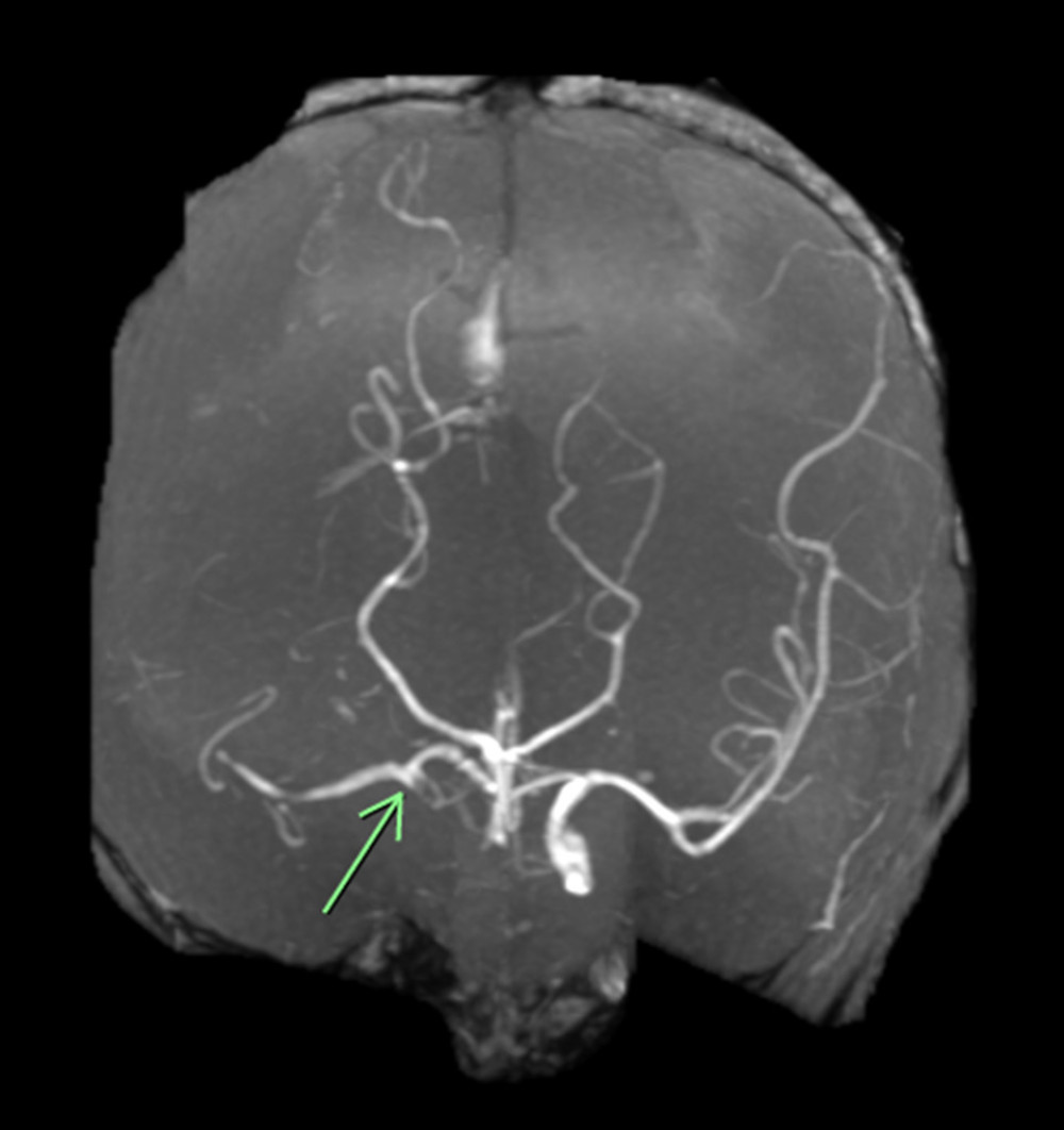 Magnetic resonance angiography (MRA) showing a patent supraclinoid portion of the internal carotid artery and M1 segment of the middle cerebral artery through a patent anterior communicating artery (arrow).