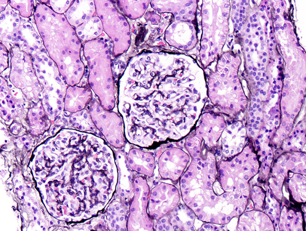 Light microscopy showing normal glomeruli and intact tubulointerstitium, ruling out interstitial disease.
