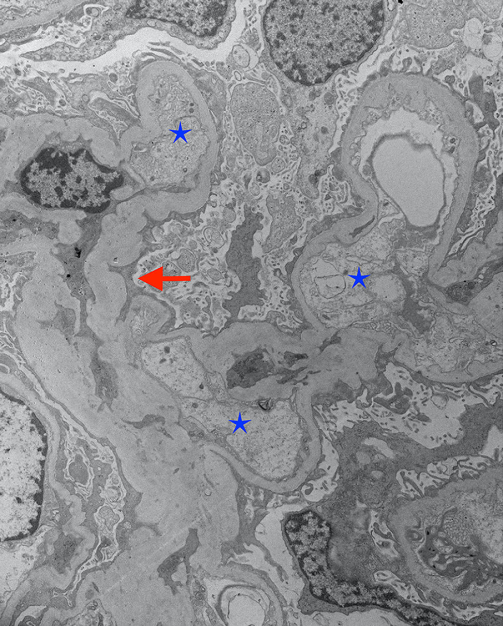 Electron microscopy showing podocyte effacement (red arrow) and swollen endothelial cells (blue stars) confirming minimal change disease.