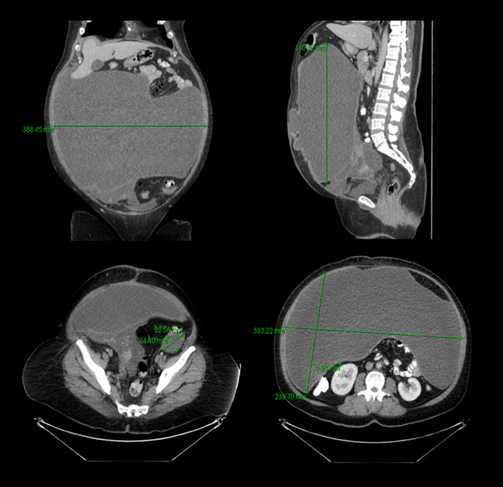 Computed tomography shows an irregular, heterogeneous, complex lesion in the right side of pelvis measuring approximately 14×11 cm, a 5.3×3.5-cm cyst in the left ovary, and a large, loculated fluid collection occupying the anterior aspect of the abdominal cavity that measures 40×24×32 cm in transverse, anterior posterior, and craniocaudal dimensions, respectively, with a thin enhancing wall.