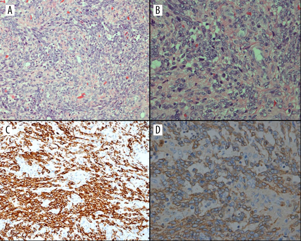 (A, B) Hematoxylin and eosin staining shows spindle-shaped tumor cells with no mitoses (100× and 200×, respectively). (C) Immunohistochemistry of the tumor for desmin. (D) Immunohistochemistry for alpha-smooth muscle actin.