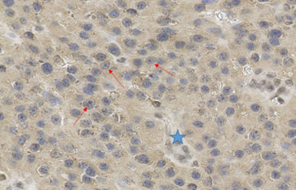 200× magnification of parathyroid carcinoma cells. Red arrows indicate cells with negative staining against parafibromin. Blue star indicates a blood vessel.