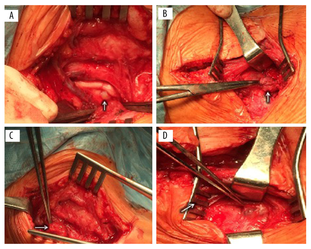 Parathyromatosis and parathyroid carcinoma. Ectopic lesions are localized in the common carotid artery, jugular vein, and vagus nerve (A); in the upper right mediastinum (B, C); and in the sternocleidomastoid muscle (D).