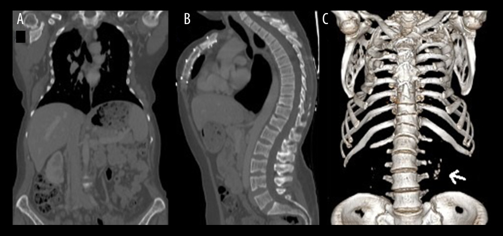 CT scans showing bone deformity: a bell-shaped thorax, increased kyphotic angle, and excessive lordosis. No brown tumors were detected. Additionally, renal calculi are seen (arrow). (A) Coronal scan. (B) Sagittal scan. (C) Three-dimensional volume reconstruction.