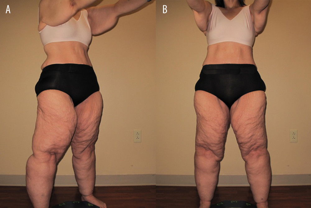 Side(A) and front (B) views of legs, arms, and torso of a woman with type 3, stage 3 lipedema of the legs and type 4, stage 3 lipedema of the arms. These photos were taken approximately 2 years after presentation to the hospital and after resolution of severe protein-calorie malnutrition and a return to her normal state of health.