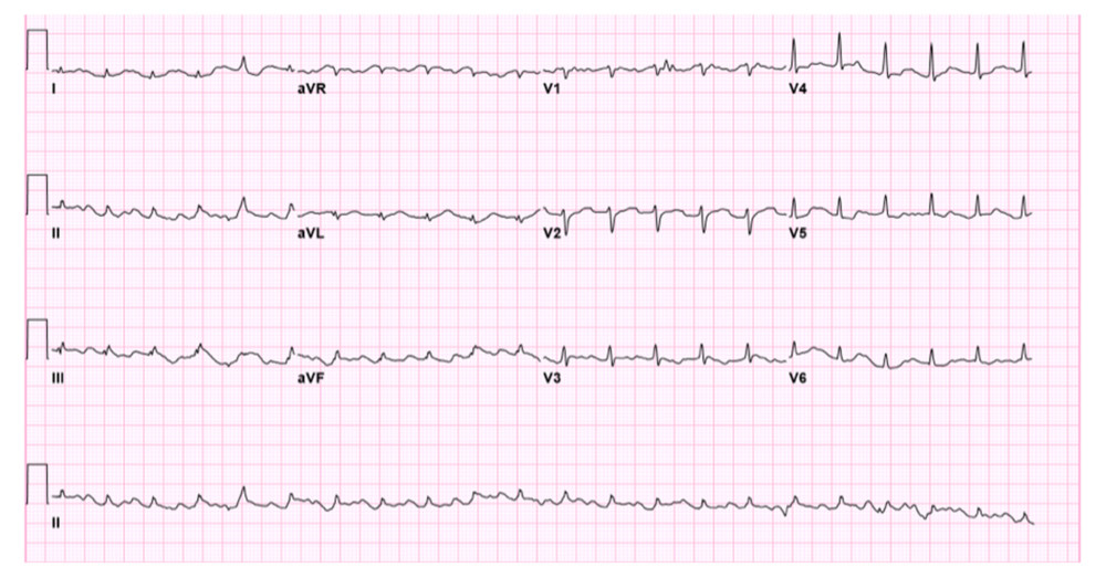 EKG immediately after cardiac arrest showing ST-segment elevation in leads II and III, with ST-segment depression in lead aVL.