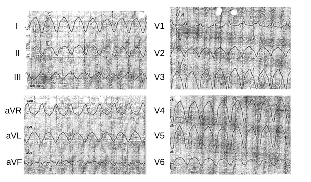 The 12-lead surface electrocardiogram showing monomorphic ventricular tachycardia, with right bundle branch block morphology, superior axis, negative QRS complexes from V2 to V6, and a cycle length of 290 ms.