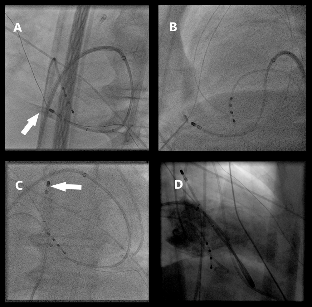 (A) Fluoroscopic left anterior oblique 40° view showing the abnormal position of the ablation catheter outside the cardiac silhouette. The white arrow indicates the contrast in the pericardial space after injection through the irrigation port of the ablation catheter. (B) Guidewire in the pericardial space during dry epicardial puncture procedure. (C) Ablation catheter advanced in the pericardial space to maintain occlusion of the aperture in the left ventricular wall. (D) Left ventricular angiography confirming the absence of ventricular leak.