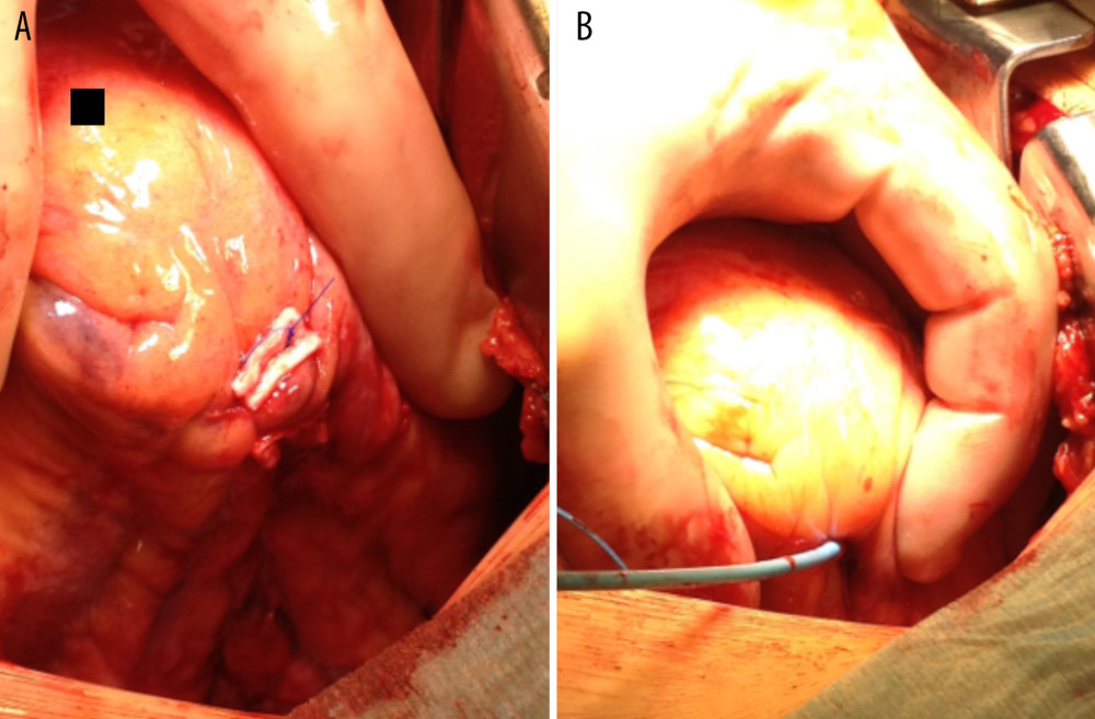 Intraoperative images. (A) Wall breach closed with mattress sutures over pledgets. (B) Ablation catheter perforation site at the apex of the left ventricle and no signs of pericardial bleeding.