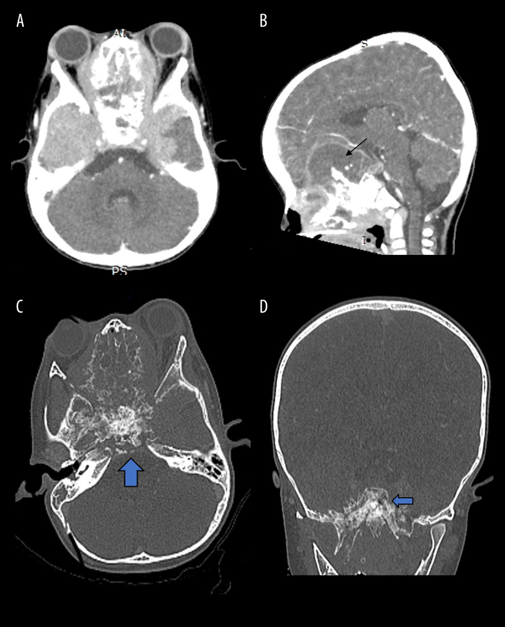 Post-contrast computed tomography (CT) scan of the brain in the (A) axial and (B) sagittal view showing infiltrative mass with a mixed solid and cystic appearance (black arrow) at the base of the skull, causing extensive local infiltration. Post-contrast CT scan of the brain in the bone setting in (C) axial and (D) coronal view showing mixed bone sclerosis and erosion in the skull base of the anterior and middle cranial fossa (blue block arrows).