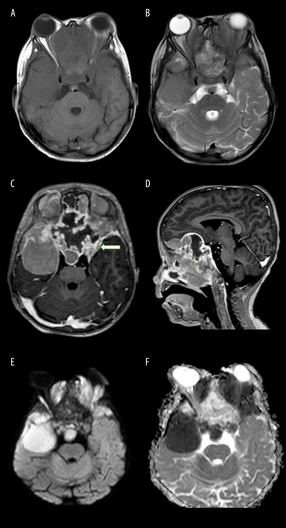 Magnetic resonance imaging of brain in (A) T1-weighted images and (B) T2-weighted images in axial section showing a predominantly T1 isointense and heterogeneous T2 hyperintense mass. Post-contrast T1 images in the (C) axial and (D) sagittal view showing a solid and cystic nasal mass (green arrow) involving both temporal bones and extending intracranially with dura thickening and enhancement (white arrow block). This mass demonstrates a significant fluid restriction seen in (E) diffusion-weighted images and (F) apparent diffusion coefficient sequences.