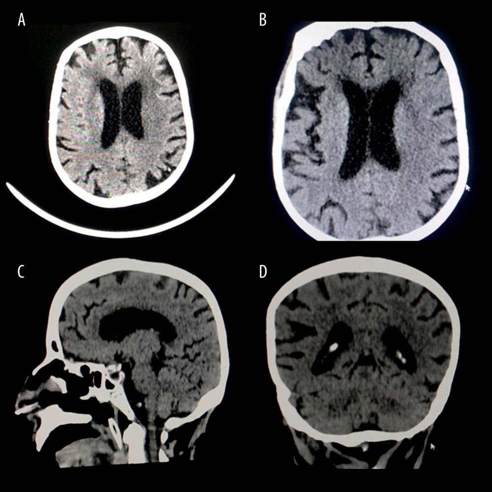 Multiple images of brain computed tomography scan (CT scan) without intravenous contrast show age-related brain atrophic changes with neither acute brain lesions nor acute ischemic changes: (A, B) axial sections; (C) sagittal section; (D) coronal section.