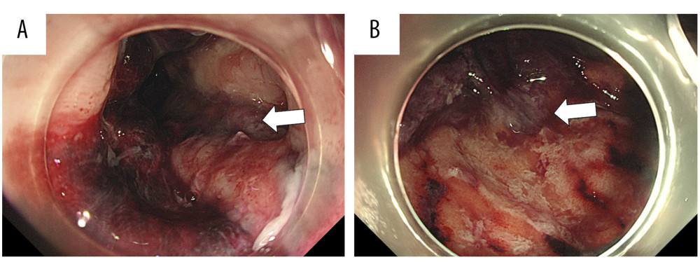 Endoscopy findings. (A) Erosions on the esophageal junction. (B) Erosions on the stomach fundus. White arrows indicate the erosions.