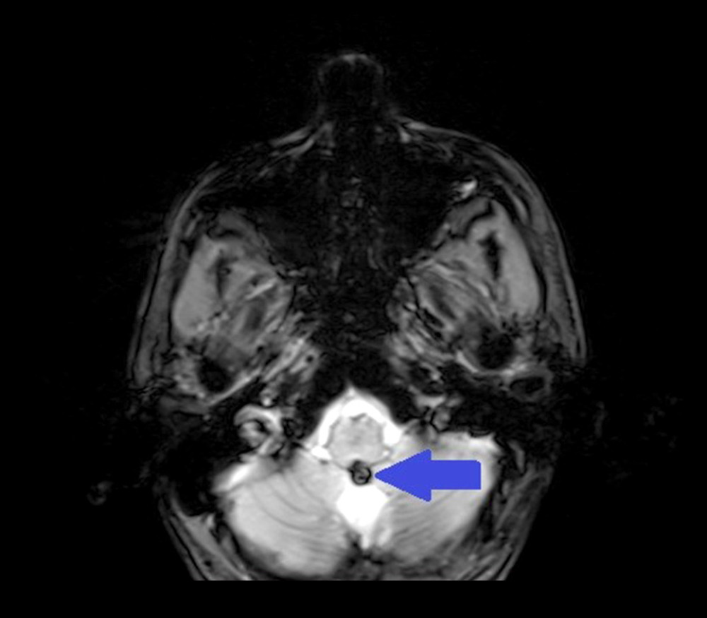 An axial gradient echo sequence magnetic resonance imaging brain scan showing the lesion (blue arrow) with a mixed-density signal indicating a bleeding of a cavernoma, extending into the fourth ventricle.