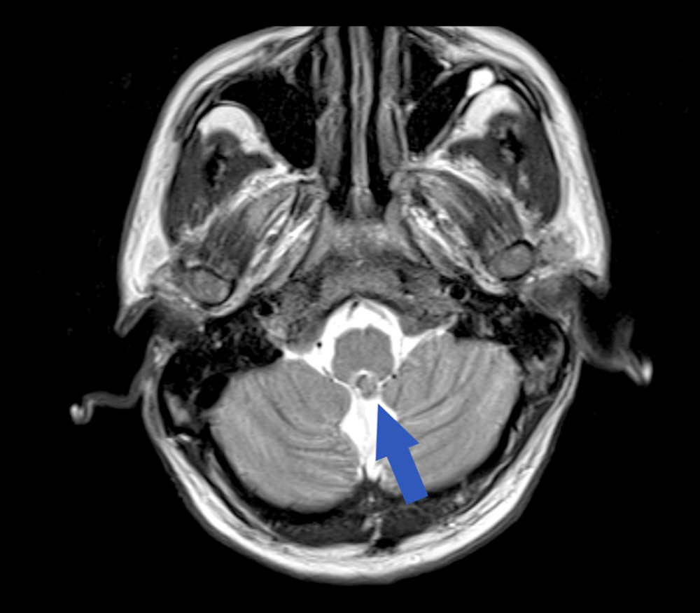 An axial T2 magnetic resonance imaging brain scan showing a well-demarcated heterogeneous signal of the pons (blue arrow), extending into the fourth ventricle.