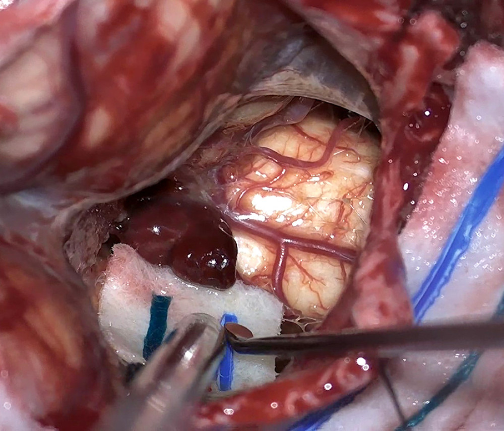 Intraoperative photograph showing the blood clot filling the fourth ventricle and the underlying medulla.
