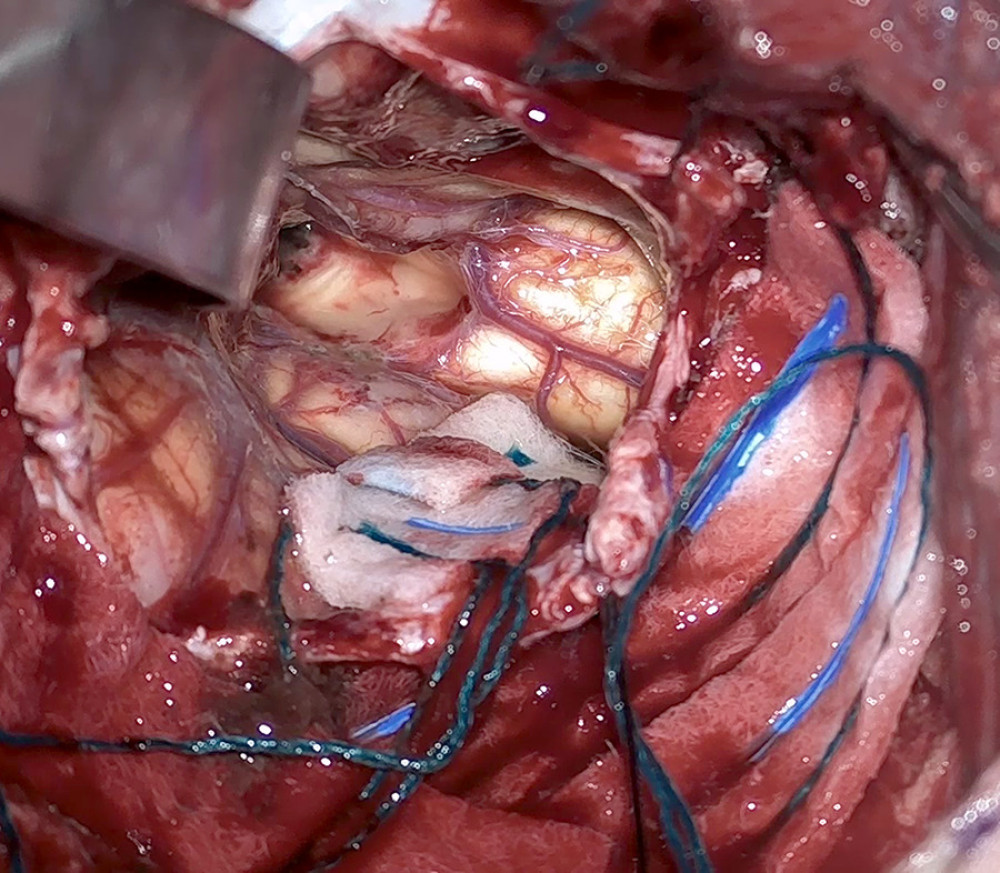 Intraoperative photograph showing the removal of the blood clot, the removal of the cavernoma, and the coagulated floor of the fourth ventricle.
