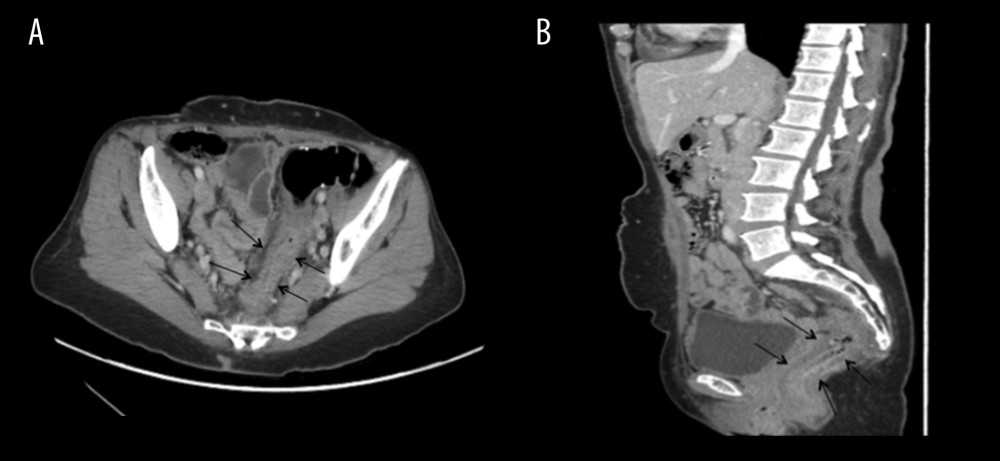 CT scan showed rectum is slightly collapsed with interval decrease of the rectal wall diffuse mural thickening suggestive of infectious/inflammatory changes. (A) Axial view and (B) sagittal view.