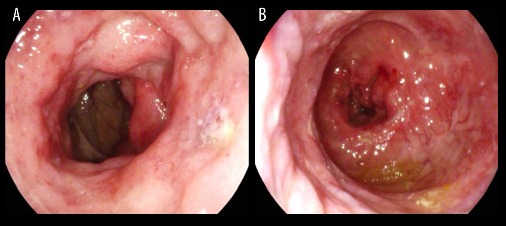 Colonoscopy findings showed (A) circumferential inflammation with loses of vascular pattern (B) significant narrowing with few rectal ulcers.
