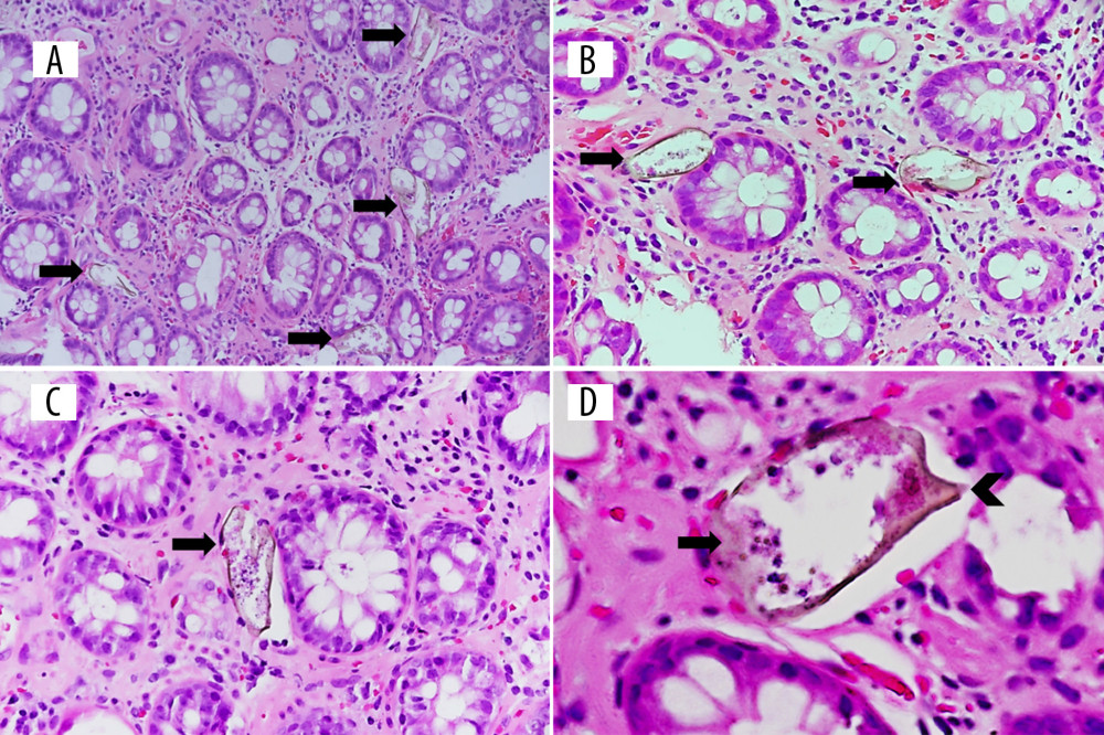 (A–D) Photomicrographs from a colonoscopic rectal biopsy shows several Schistosoma eggs (arrows) embedded in the lamina propria of the rectal mucosa. The Schistosoma eggs are yellowish brown, elongated to ovoid with a refractile shell. The large eccentric lateral spine projecting near one end (arrowhead) is a characteristic feature of a Schistosoma mansoni eggs. In addition, the rectal mucosa shows mild hyalinization of the lamina propria with mild chronic inflammation, edema, and extravasated red blood cells. There is no dysplasia or invasive carcinoma seen. This biopsy was diagnosed as schistosomiasis of the large intestine in which the location and histomorphology of the eggs are consistent with Schistosoma mansoni infection (hematoxylin and eosin stain, original magnification ×100, ×200, ×400, and ×600, respectively).