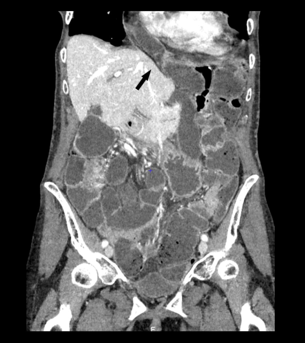 A coronal computed tomography view of the incarcerated pericardial small-bowel hernia causing obstruction. The arrow shows the diaphragmatic hernia just next to the left liver lobe.