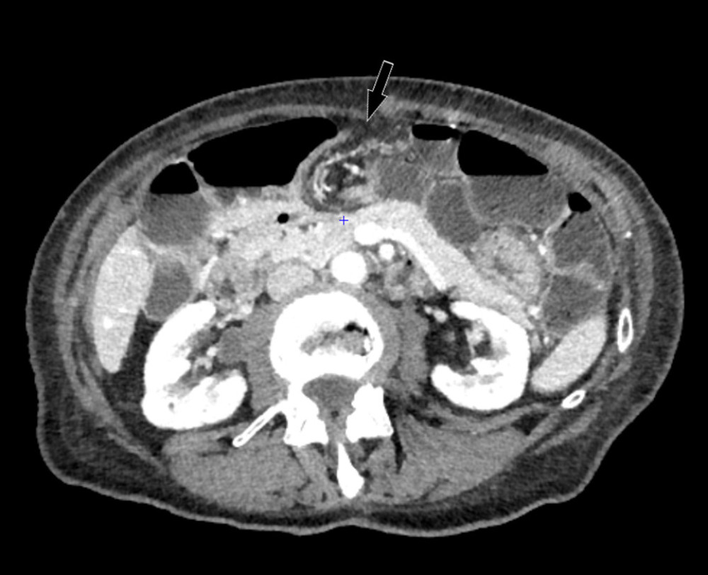 The transverse computed tomography view of the pericardial hernia. As shown by the arrow, the involved bowel mesenteric vessels present an incomplete “whirlpool sign” due to traction on the vascular pedicle.