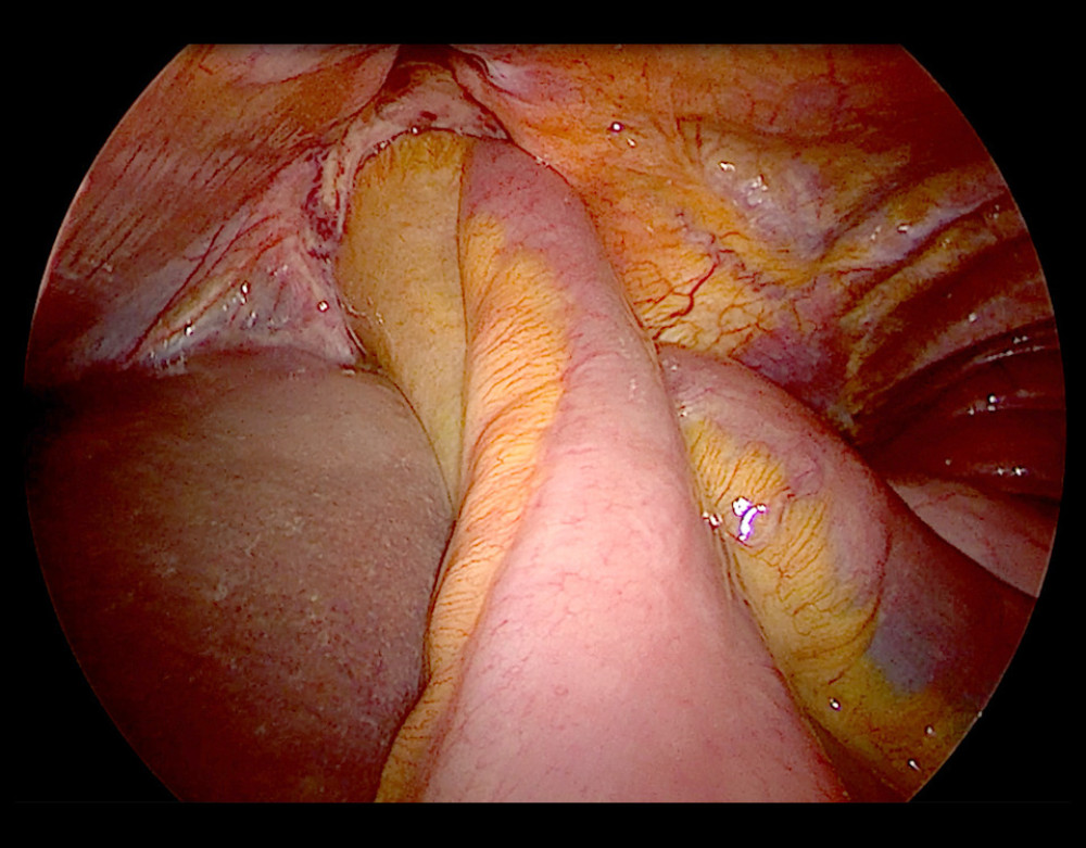 An intraoperative view of the incarcerated “closed loop type” small-bowel obstruction within the pericardioperitoneal window.