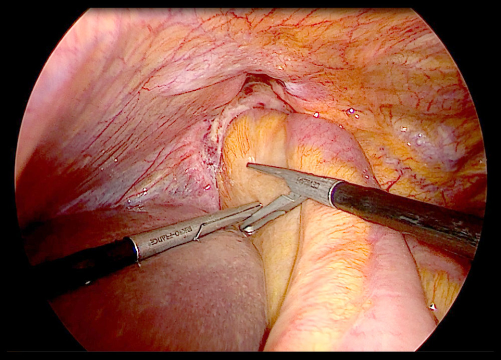 Laparoscopic reduction of the incarcerated pericardial hernia.