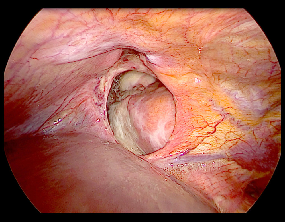 Pericardio-peritoneal window as a defect before closure with the mesh.