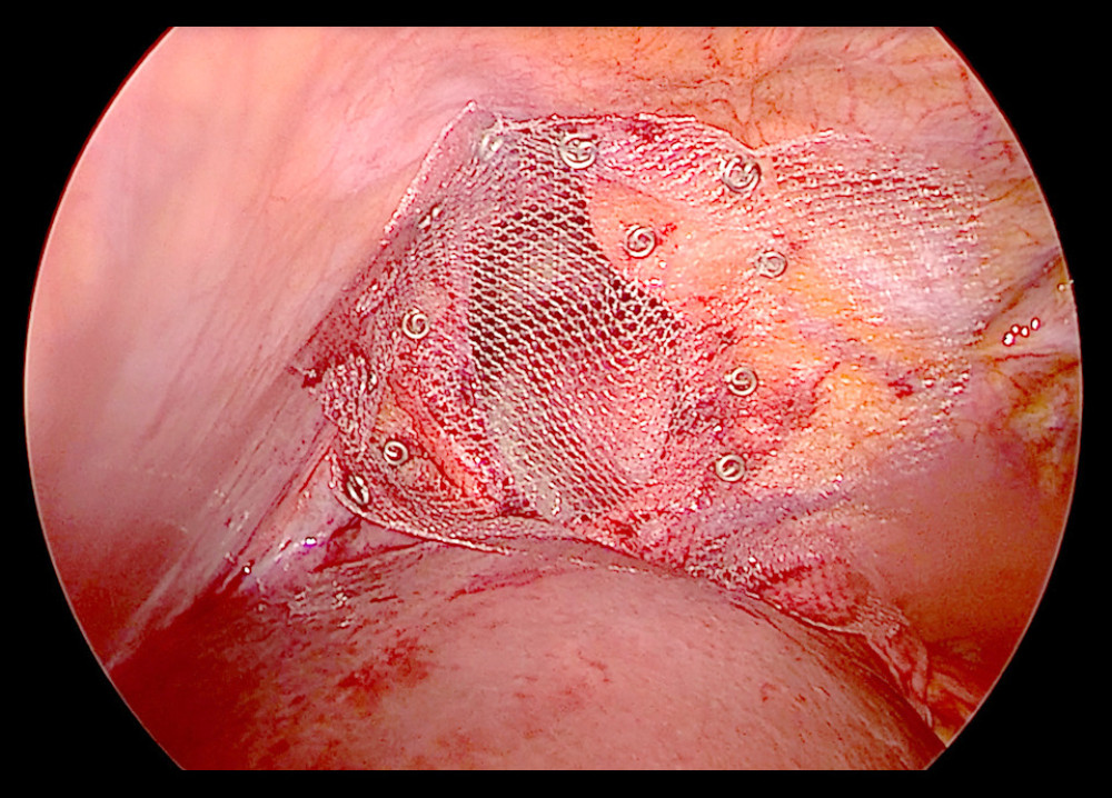 Final image of the nonabsorbable, noncovered mesh placement with nonabsorbable laparoscopic tacker fixation.
