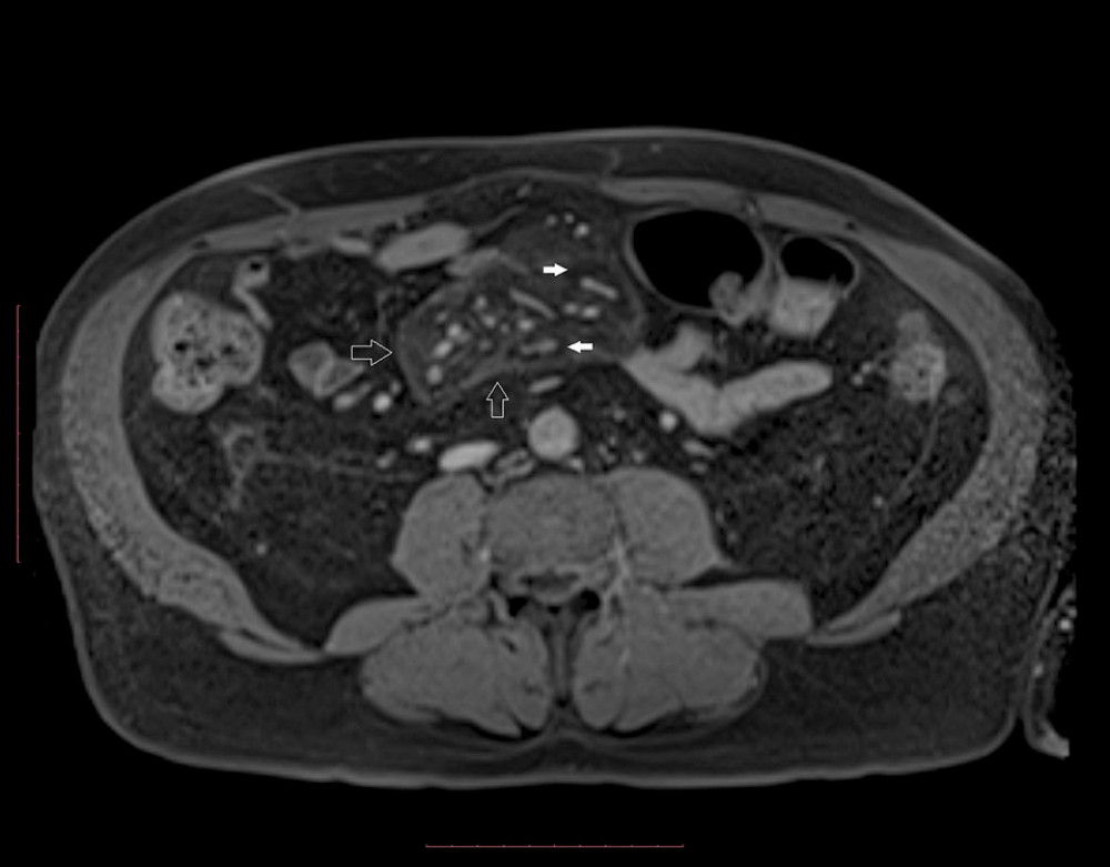 Contrast-enhanced T1 GRE fat-saturated image shows a well-demarcated mass-like lesion in the mesentery with the presence of a capsule (open arrows) and spared fat around traversing vessels (white arrows). The image strongly suggests sclerosing mesenteritis.
