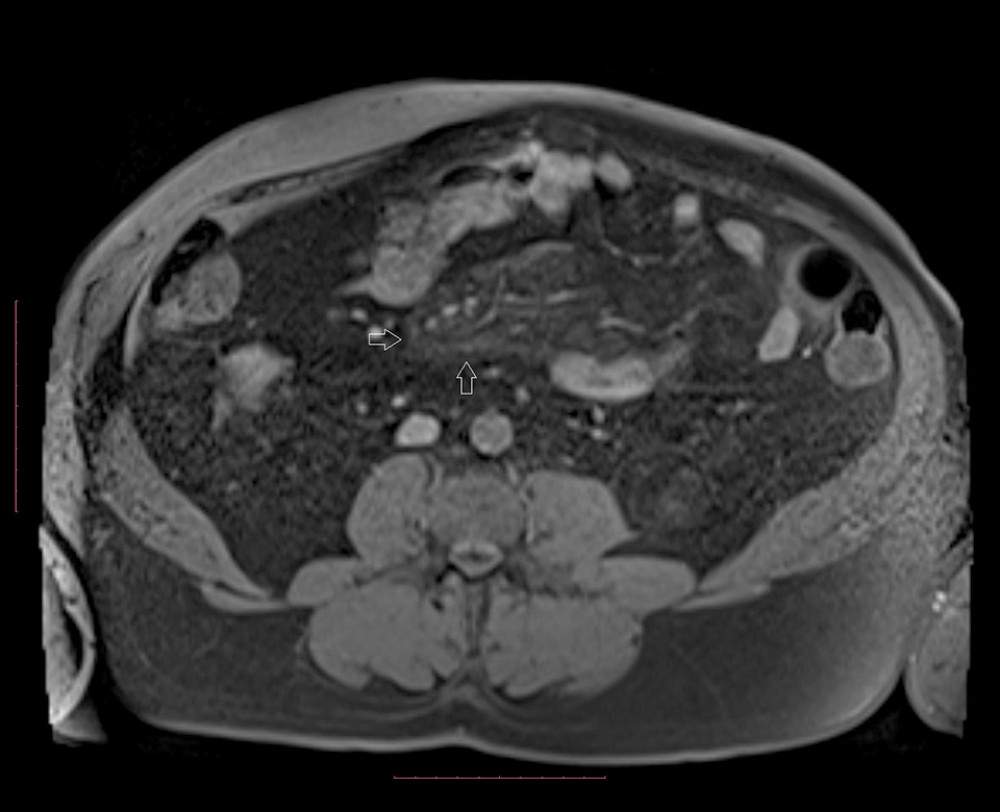 Control MRI study after treatment shows partial regression of the lesion, which is smaller and less demarcated (open arrows).