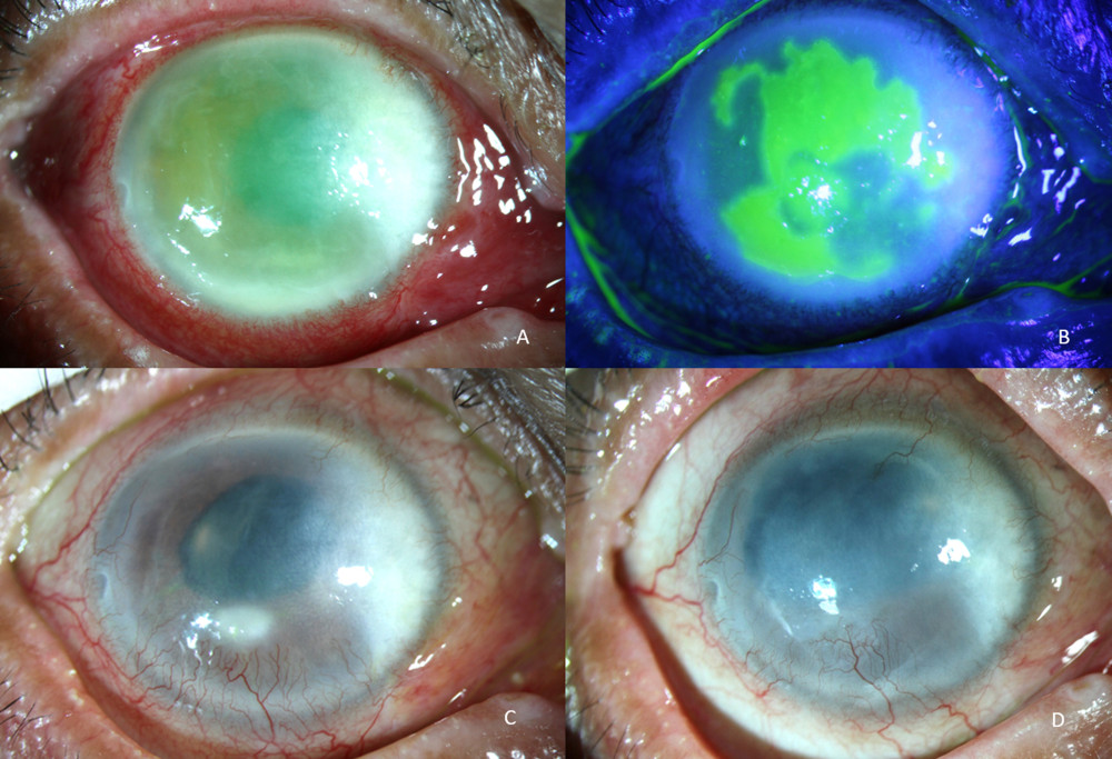 Slit-lamp photographs showing corneal lesion of patient No. 1 (A, B) At the first presentation, demonstrating classic clinical corneal lesion of geographic epithelial keratitis. (C) At 2 weeks after healing of epithelial keratitis, showing new paracentral anterior stromal infiltration with overlying epithelial defect. (D) After intravenous acyclovir treatment, resolution of corneal infiltration and healing of epithelial defect.