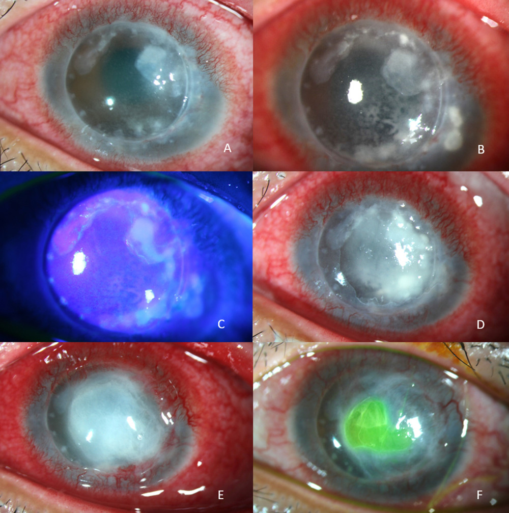 Slit-lamp photographs showing clinical progression of patient No. 2. (A) On day 1, eccentric, well-defined edge anterior one-third of stromal infiltration with overlying epithelial defect. (B, C) On day 3, progression of anterior stromal infiltration and scalloped-shaped border of epithelial defect demonstrated by fluorescein staining. (D) On day 7, multifocal, large, deep and dense anterior stromal infiltration with corneal melting. (E) On day 12 (after 3 days of intravenous acyclovir), improvement of stromal infiltration, but still of stromal melting at center of the lesion. (F) On day 30 (after 1 week of autologous serum eye drops), improvement of corneal melting and decreasing size of epithelial defect.