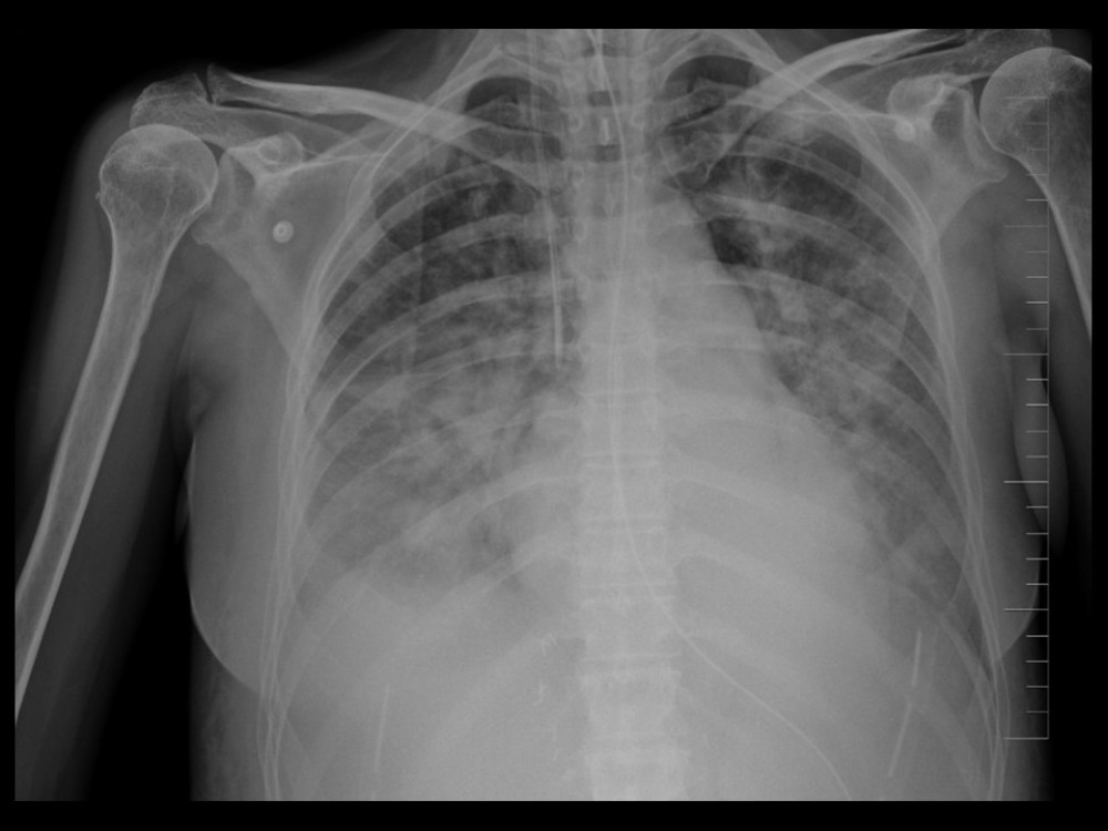 Chest X-ray of the patient showing pulmonary edema.