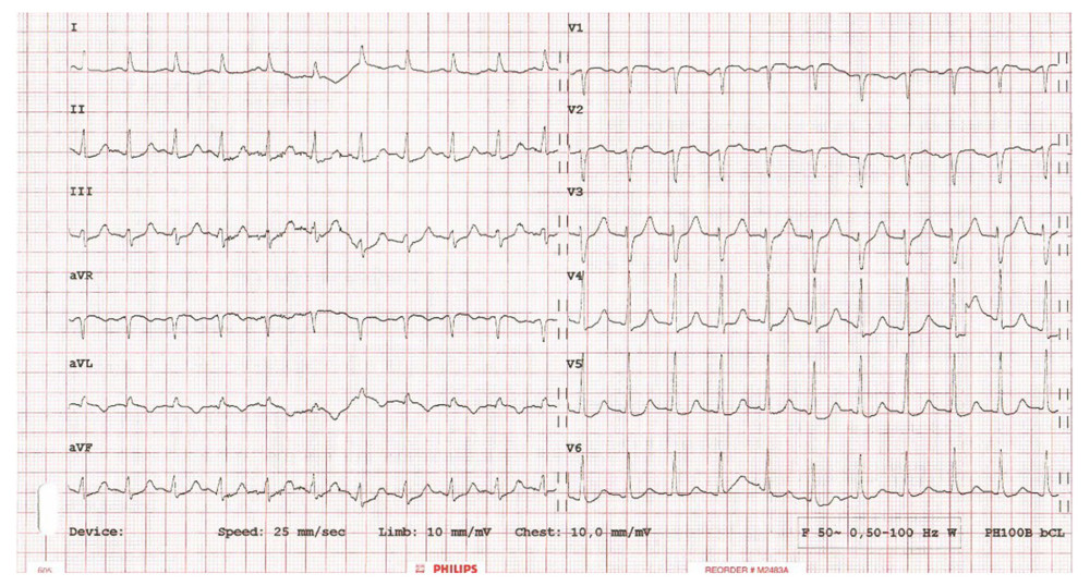 The patient’s electrocardiogram showing sinus tachycardia and nonspecific changes.